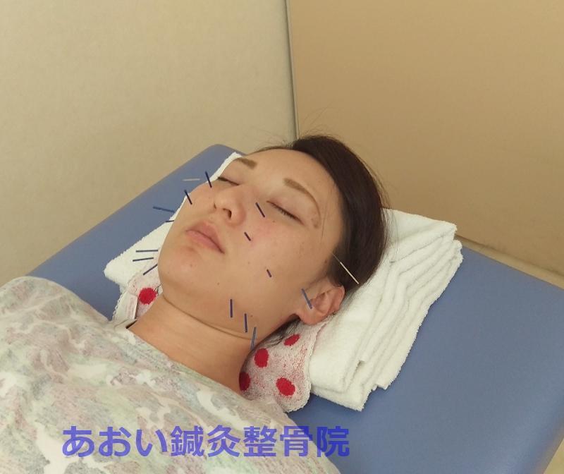 美容鍼灸＋美顔矯正