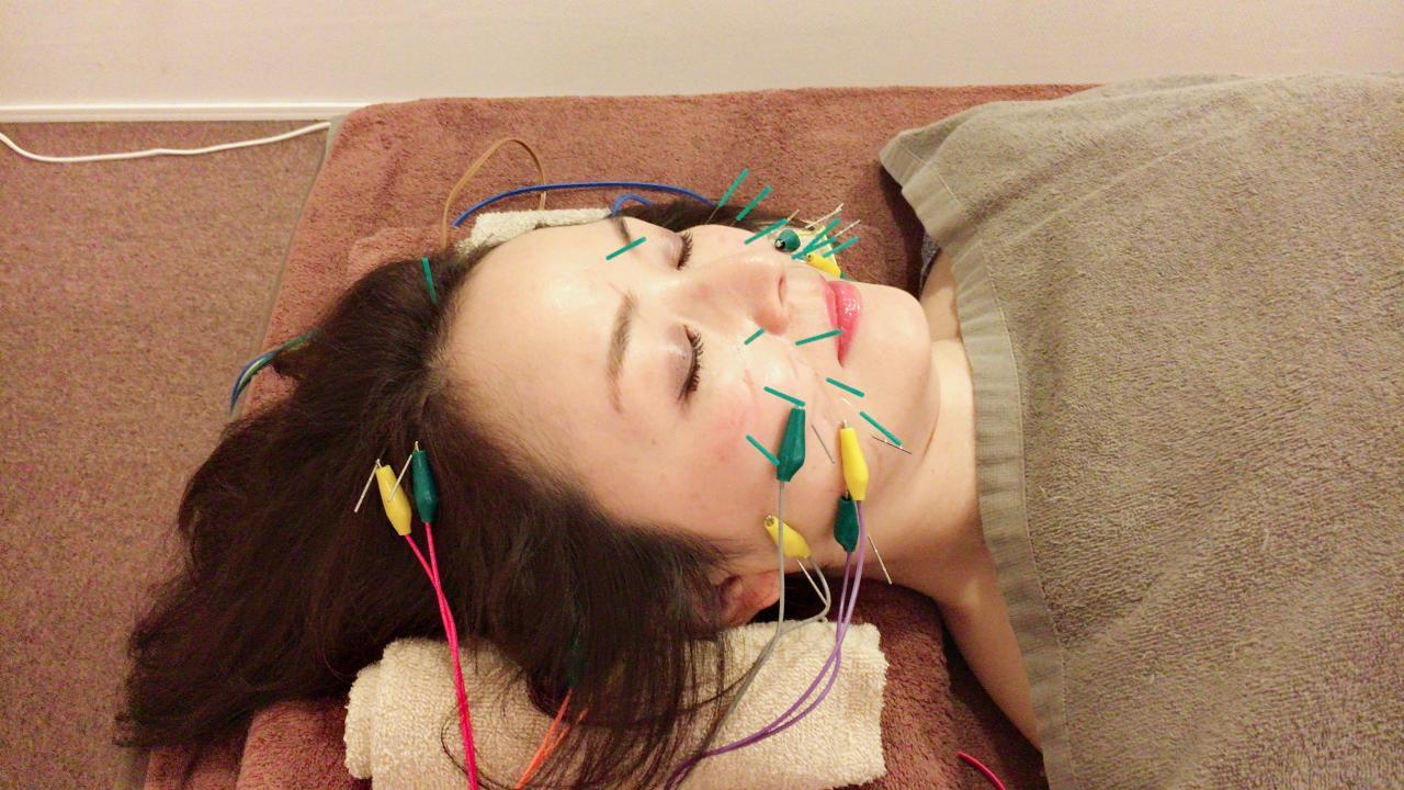 リフトアップ美容鍼　60分